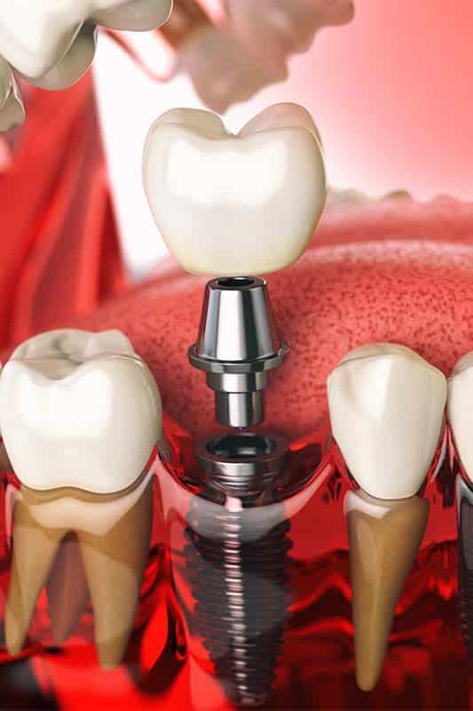 implantes dentarios algarve
