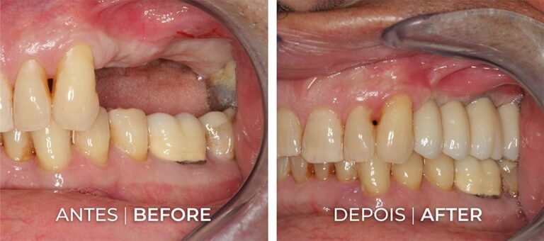Implantes Dentários