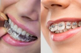 Price of Braces in Portugal (2026)