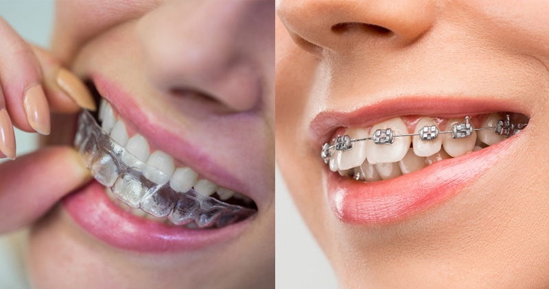 Invisalign aligner and metal braces for tooth positioning correction