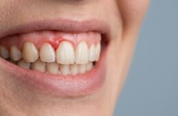 O que é gengivite? Causas, sintomas e prevenção