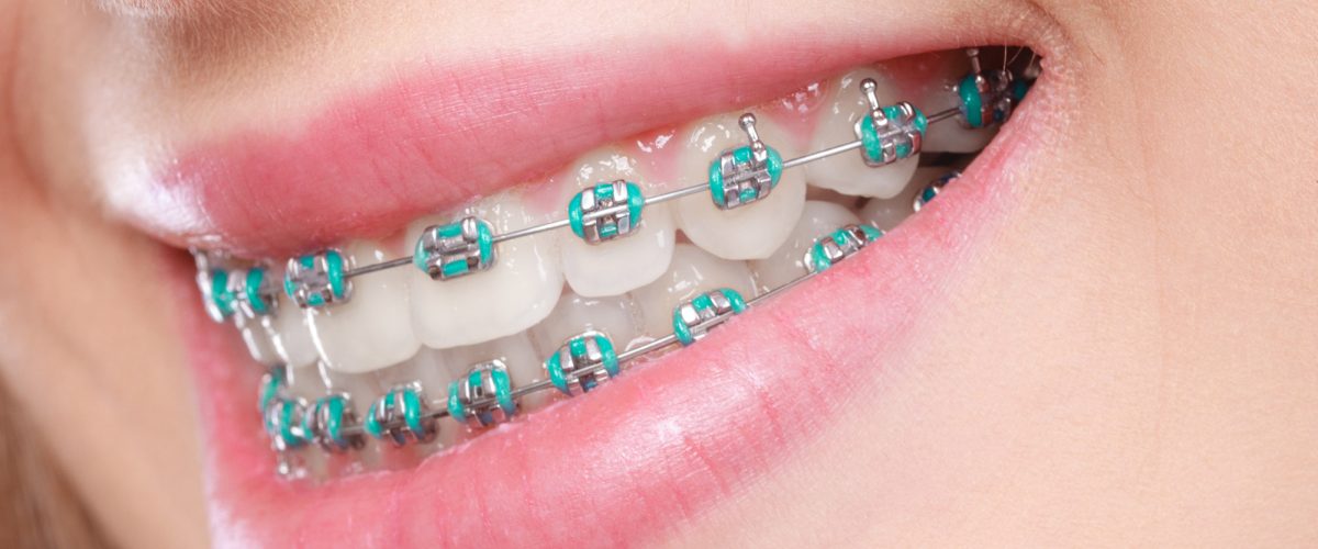 Traditional metal braces with elastics for orthodontic treatment