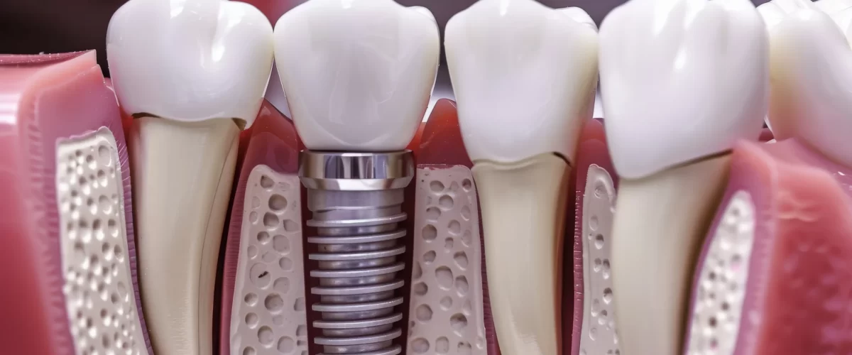 nobel-biocare-dental-implant-system-strong-natural-looking-teeth